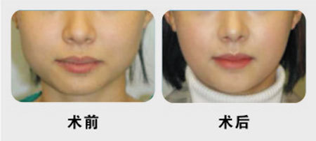 脸部吸脂费用是多少