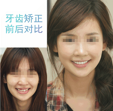 牙齿矫正变美吗
