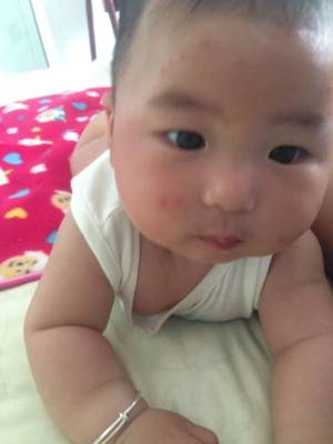 头部后面长痘痘是什么原因