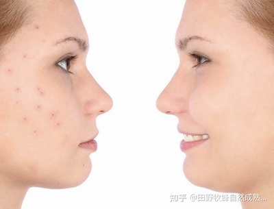 痘痘肌可以用蜂蜜敷脸吗