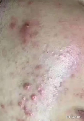 催熟红肿痘痘
