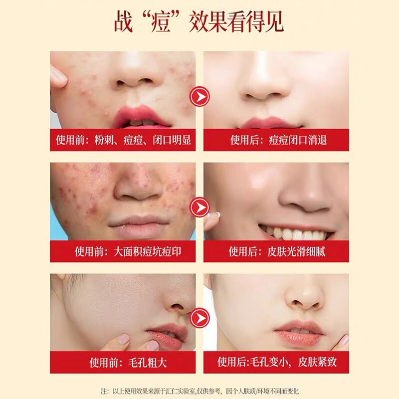 痘痘男護膚哪個好