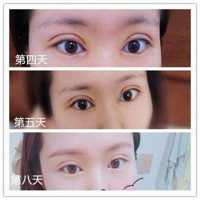 双眼皮的坏处