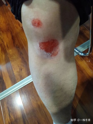 膝盖软是怎么回事