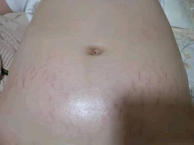 怀孕多久妊娠纹会出现