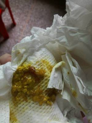 六个月宝宝大便有血丝