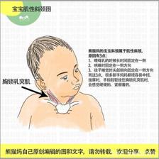 新生儿斜颈