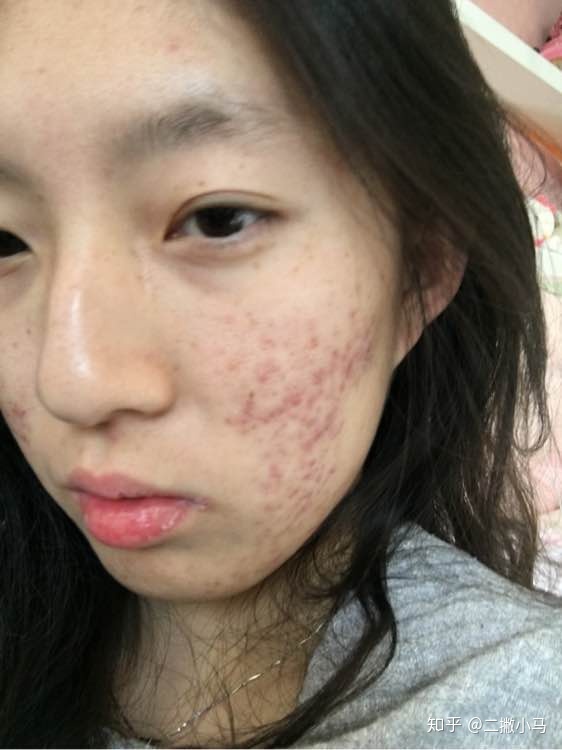 脓包型痤疮怎么治疗