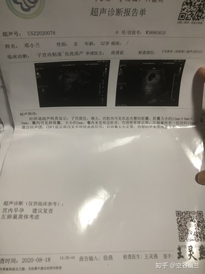 宫腔镜做完多久可以怀孕