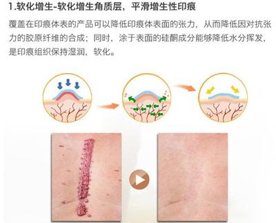 怎么确定是不是疤痕体质