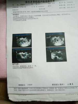 怀孕五周孕吐正常吗