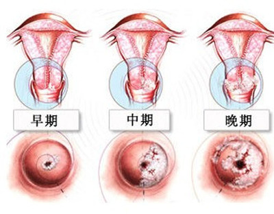 宫颈癌