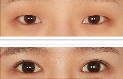 做完双眼皮有淤血怎么办