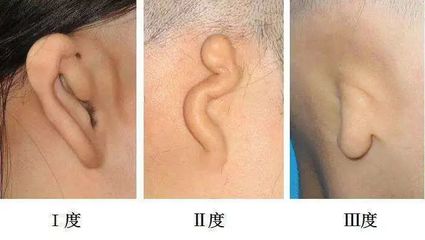 新生儿外耳畸形