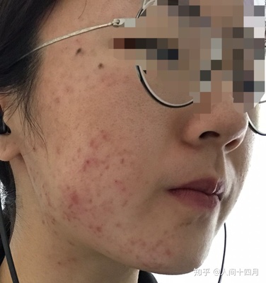 30多岁 右脸长痘痘