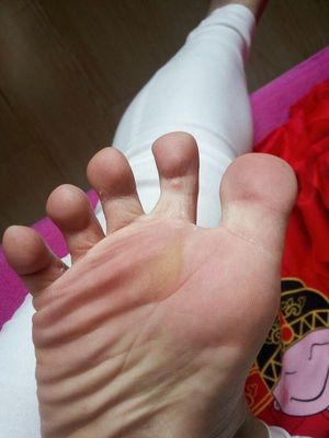 怀孕脚气怎么办