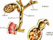 胆管结石怎么治疗