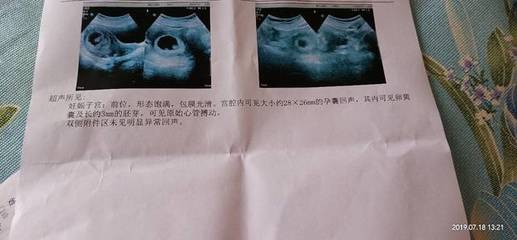 甲亢对胎儿有什么影响