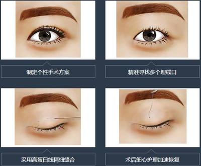 蛋白线双眼皮是永久的吗