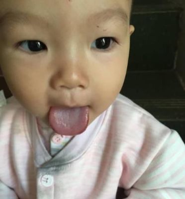 小孩舌头发白是怎么回事