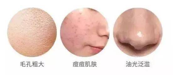 晒太阳对痘痘好吗