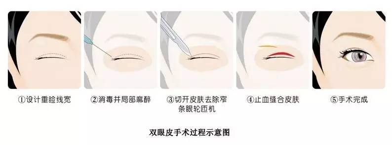 做完双眼皮冰敷多久