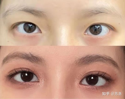 全切双眼皮照片