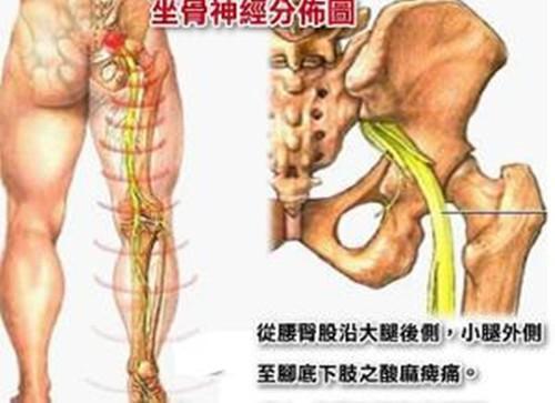 腰间盘突出压迫神经怎么治疗