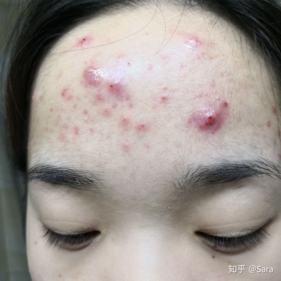 脸上起痘痘留疤怎么办
