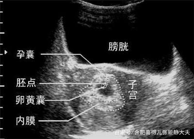 怀孕空囊的原因