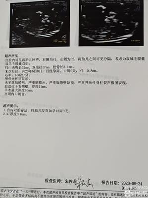 足月胎儿股骨长标准