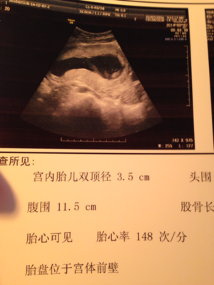 胎儿双顶径一月长多少正常吗