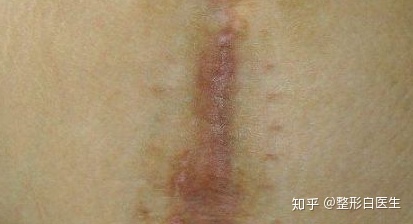 怎么判断自己是疤痕体质