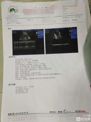 胎儿脐绕颈一周