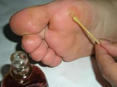 脚底湿疹怎么治疗