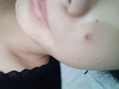 点痣几天结痂