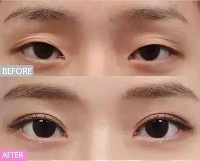 眼睛凹陷可以做双眼皮吗