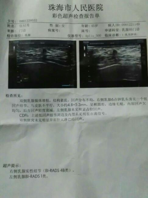 乳腺低回声结节是怎么回事