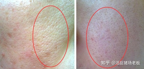 男生脸部毛孔粗大怎么办