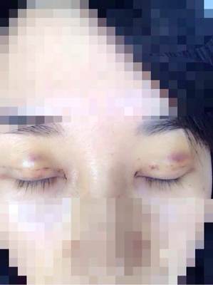 双眼皮结痂多久掉