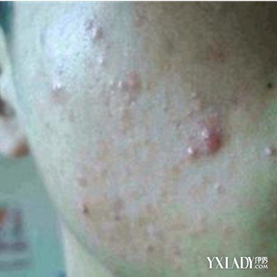 治疗脸部痤疮方法