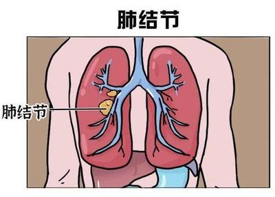 肺结节是怎么回事