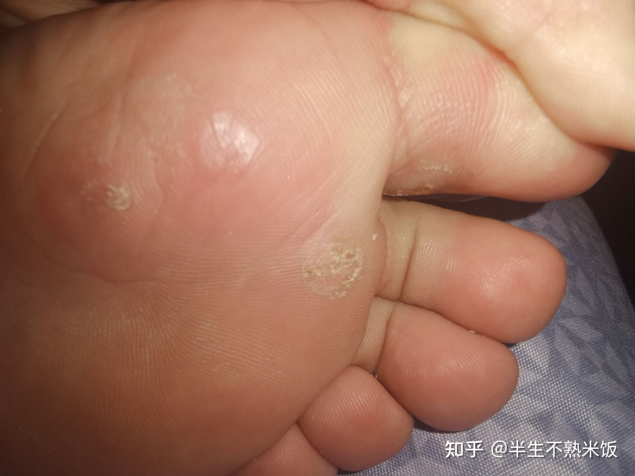 疣体一个月能长大多少