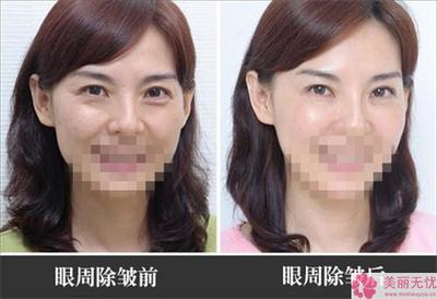 保妥适除皱效果怎样