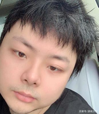 初中生男孩脸上长痘痘怎么治疗