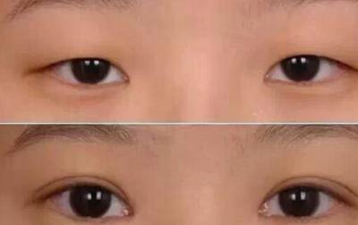割双眼皮什么样的好