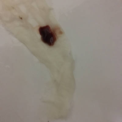 来月经的时候有血块是怎么回事