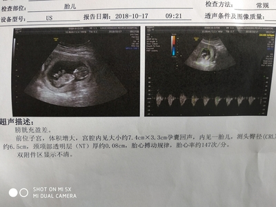 胎儿头偏大是什么原因