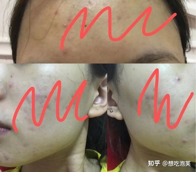 男的恋爱后长痘痘