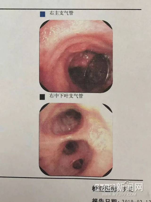 痰中带少量血丝是怎么回事
